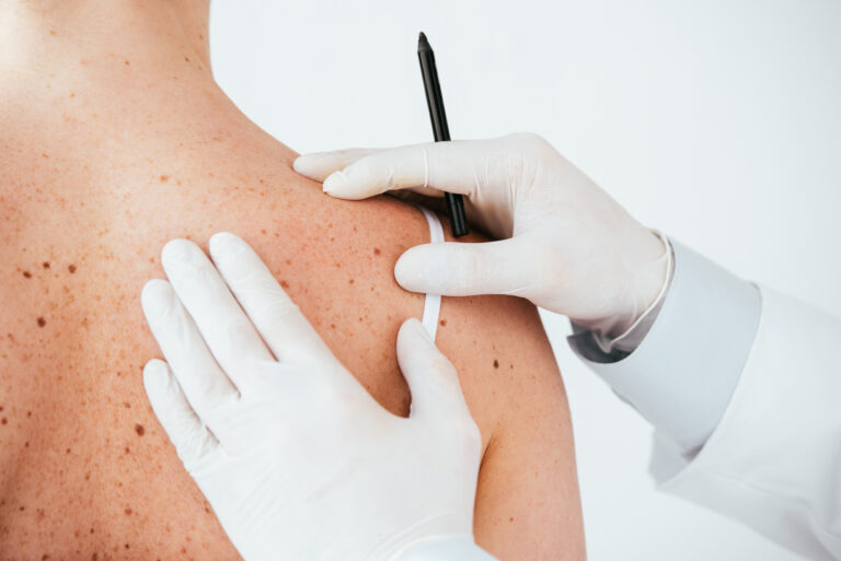 Melanoma