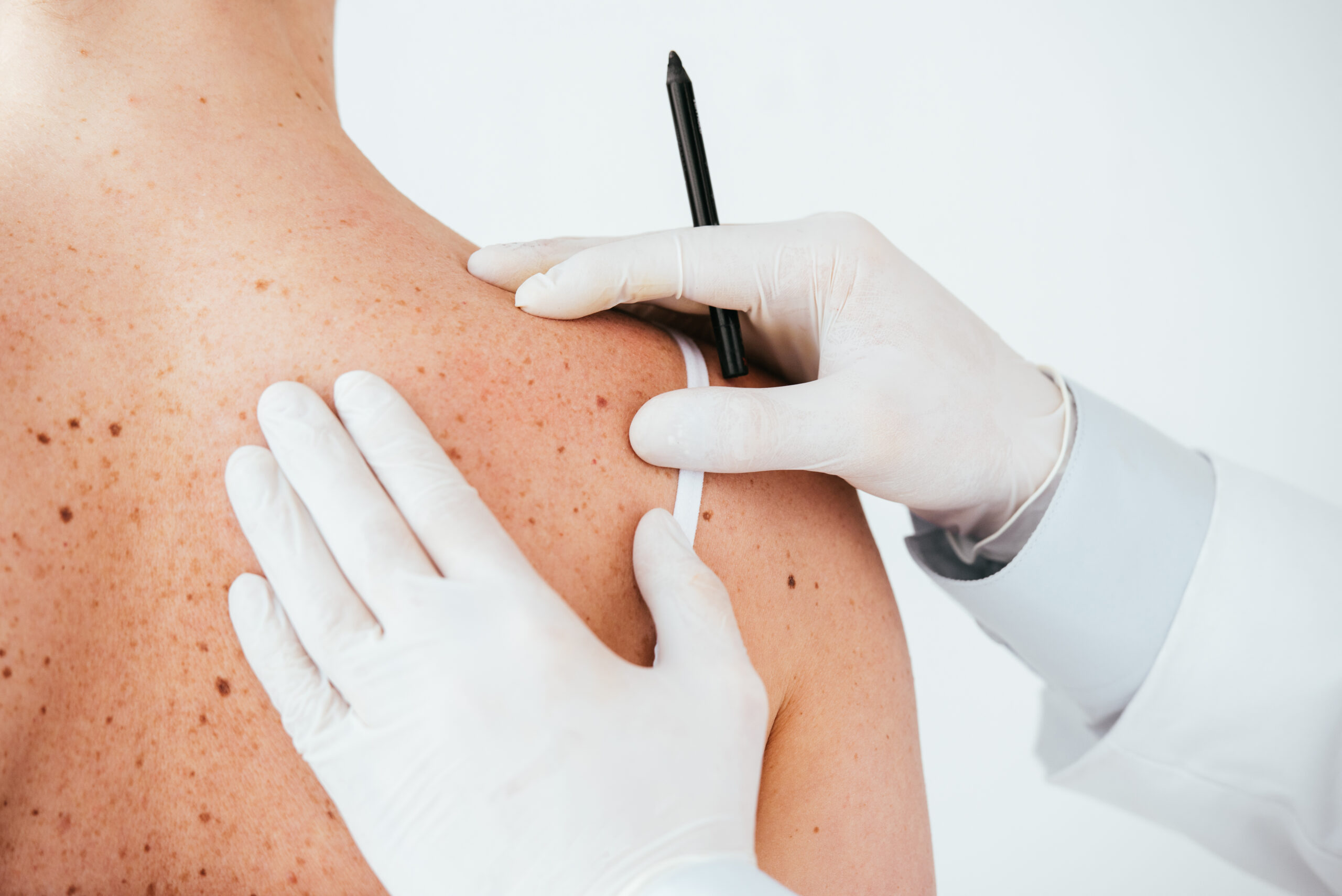 Melanoma