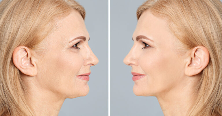 Ultherapy