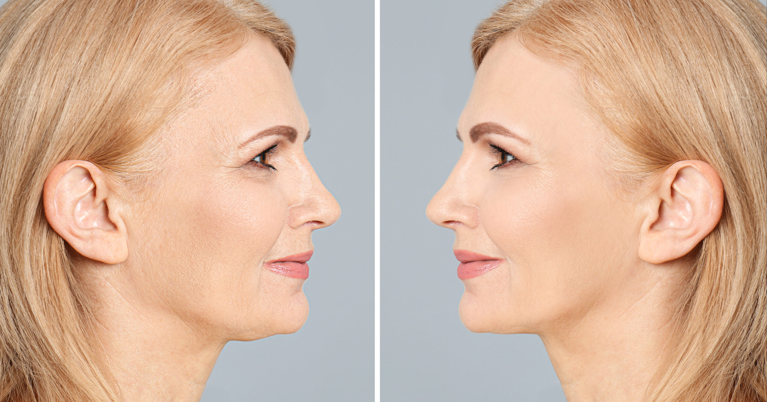 Ultherapy