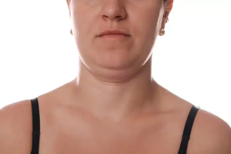 CoolSculpting for a Double Chin