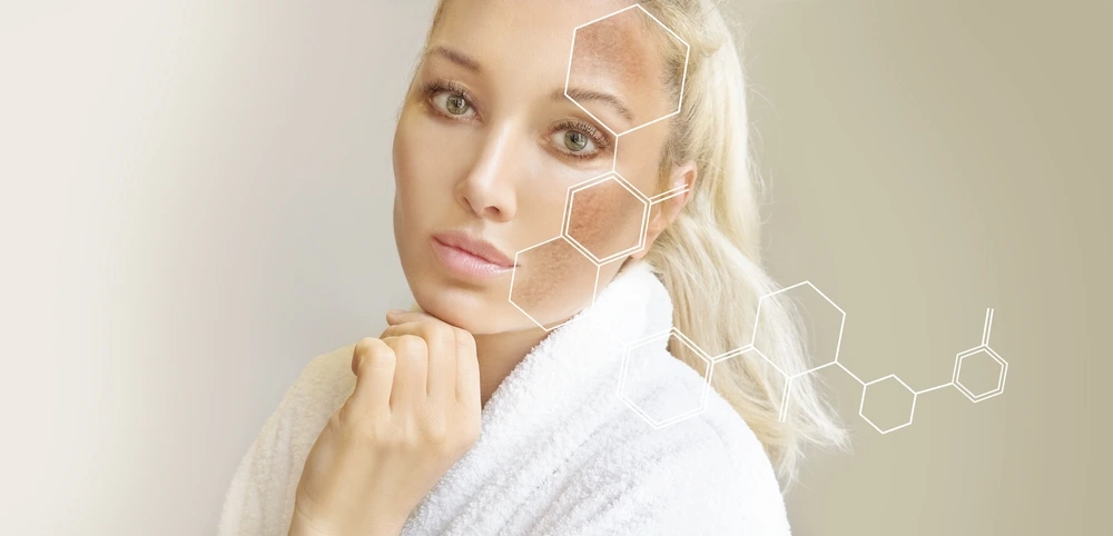melasma