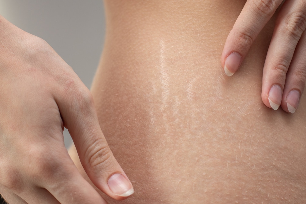 Stretch marks