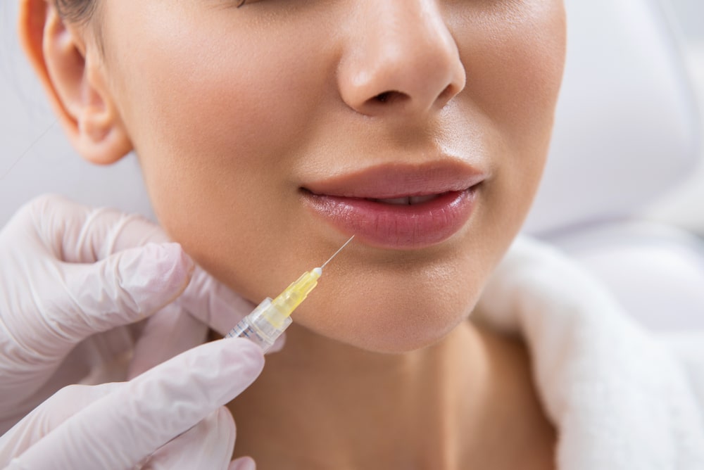 Lip Fillers Lakeland