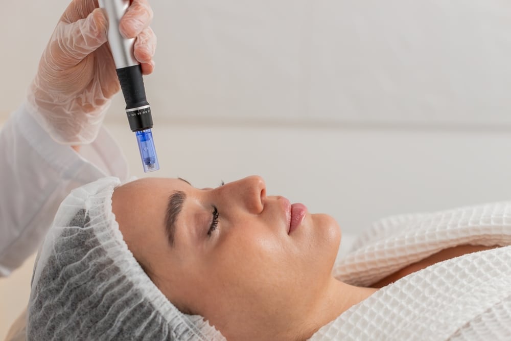 Microneedling-Tampa