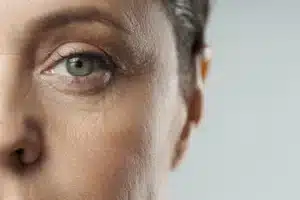 crows feet
