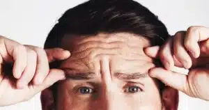forehead lines